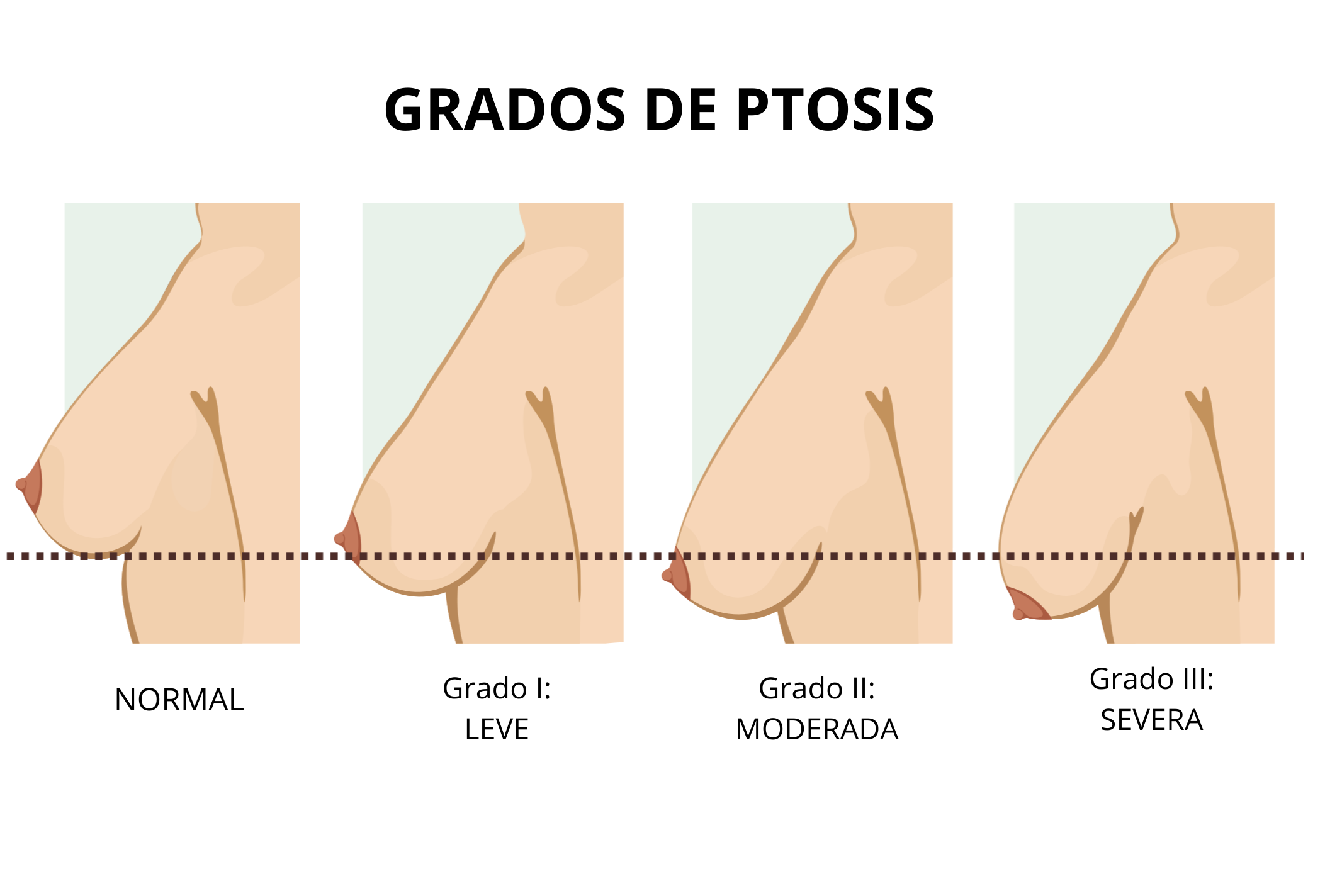 El sujetador postoperatorio tras la intervención de pecho - Blog de  Masquemedicos