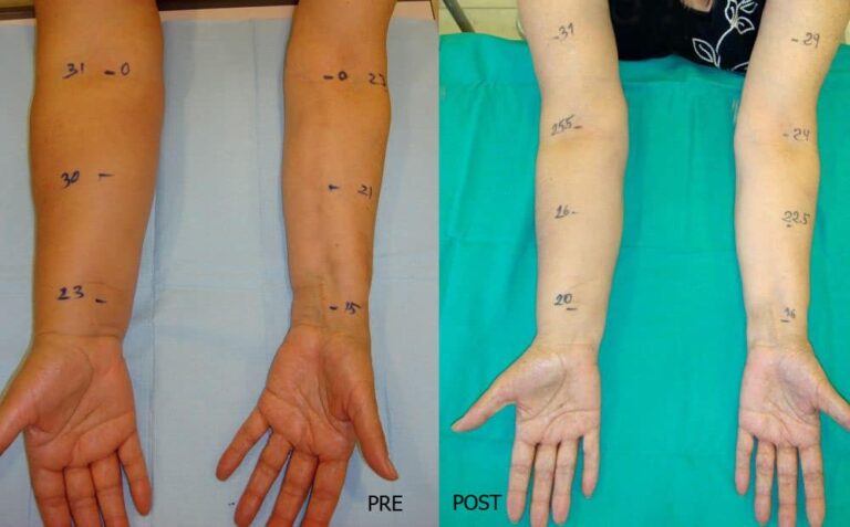 El Protocolo Para El Tratamiento Del Linfedema Dr Planas Blog