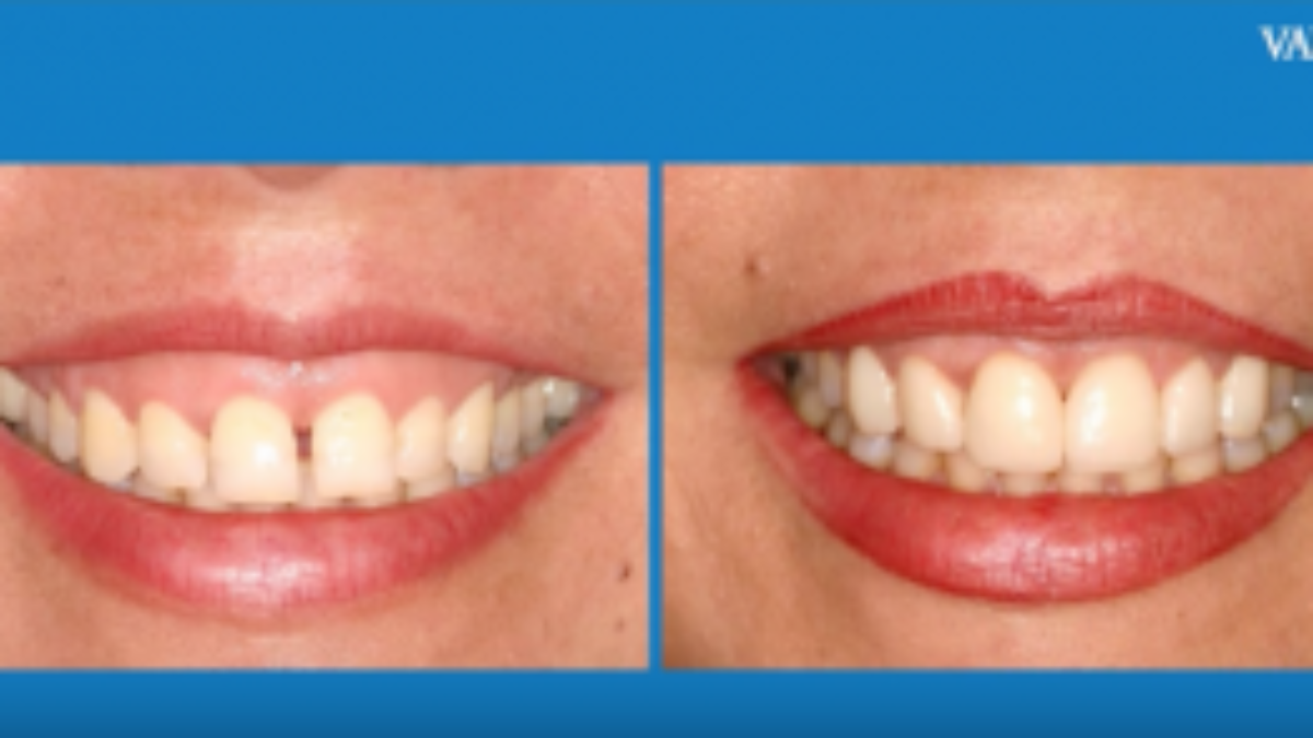 Sonrisa gingival: cómo corregirla - CLINICA DENTAL VIGO RIOSDENT