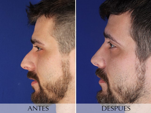 Rinoplastia Clinica Planas Barcelona Madrid