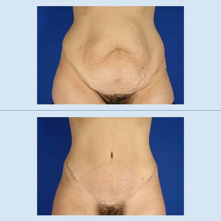 Cirugía parágrafo tener abdomens plano - Abdominoplastia - Dois cursos -  CENTRO DE CIRURGIA PLÁSTICA, BEAUTY AND DAY SPA