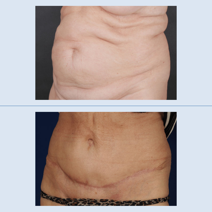 Antes y Después Abdominoplastia