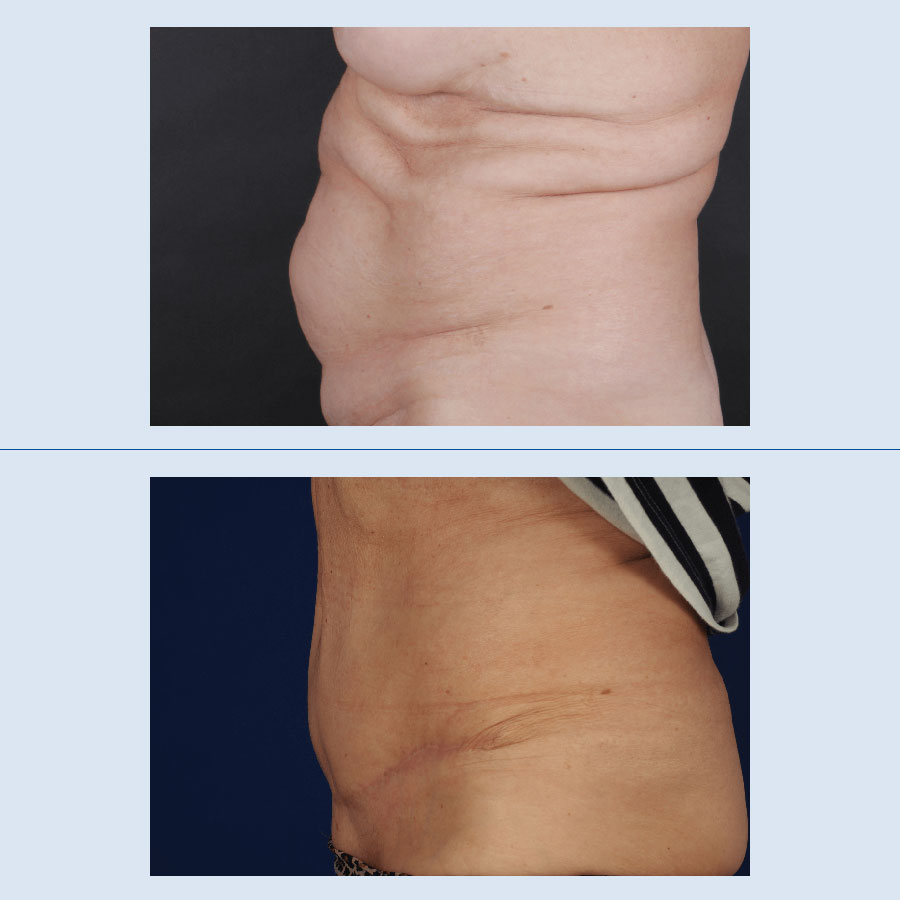 Antes y Después Abdominoplastia