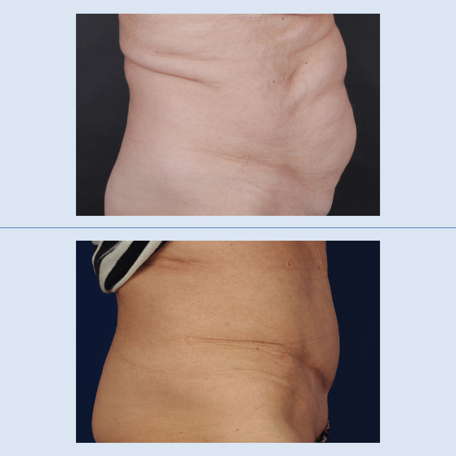 Antes y Después Abdominoplastia